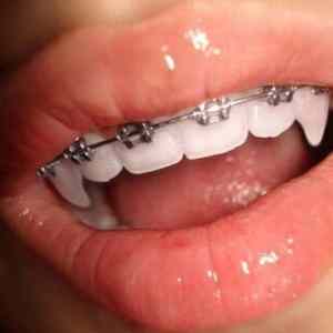 Obrázek 'Vampire Braces'