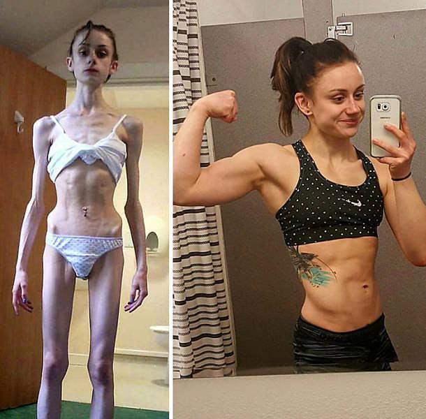 Obrázek anorexia is not the final verdict 