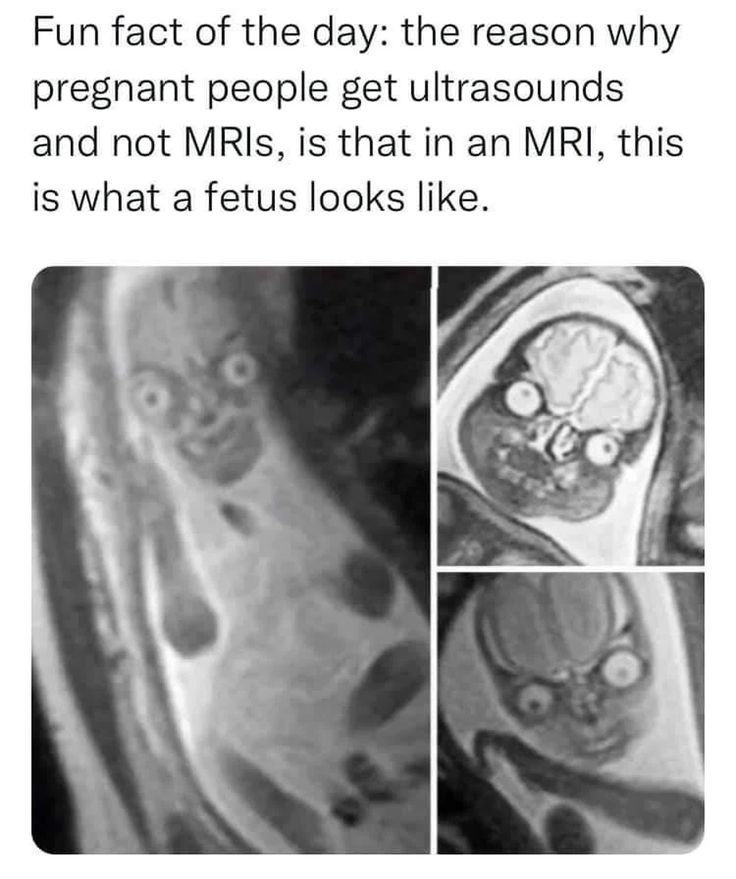 Obrázek fakt fetus